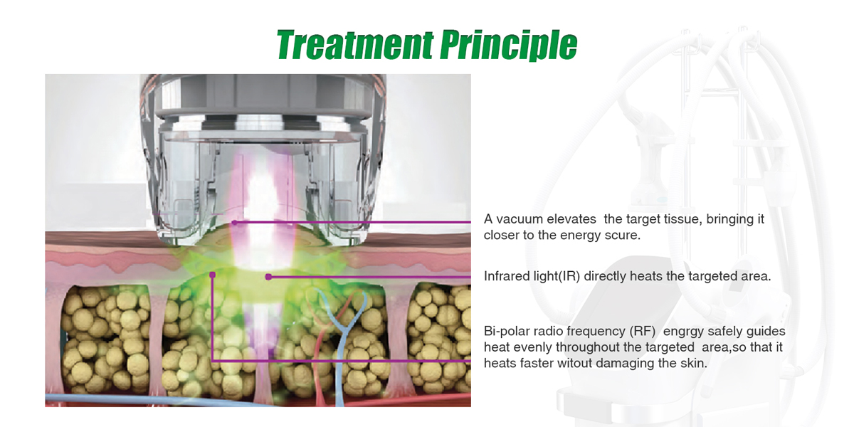 v shaping + rf roller system v shaping + rf roller system
