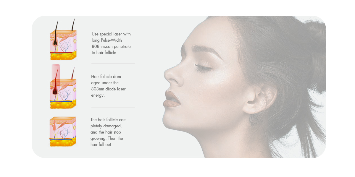 Diode_Laser_Hair_Removal_Machin_(2).jpg