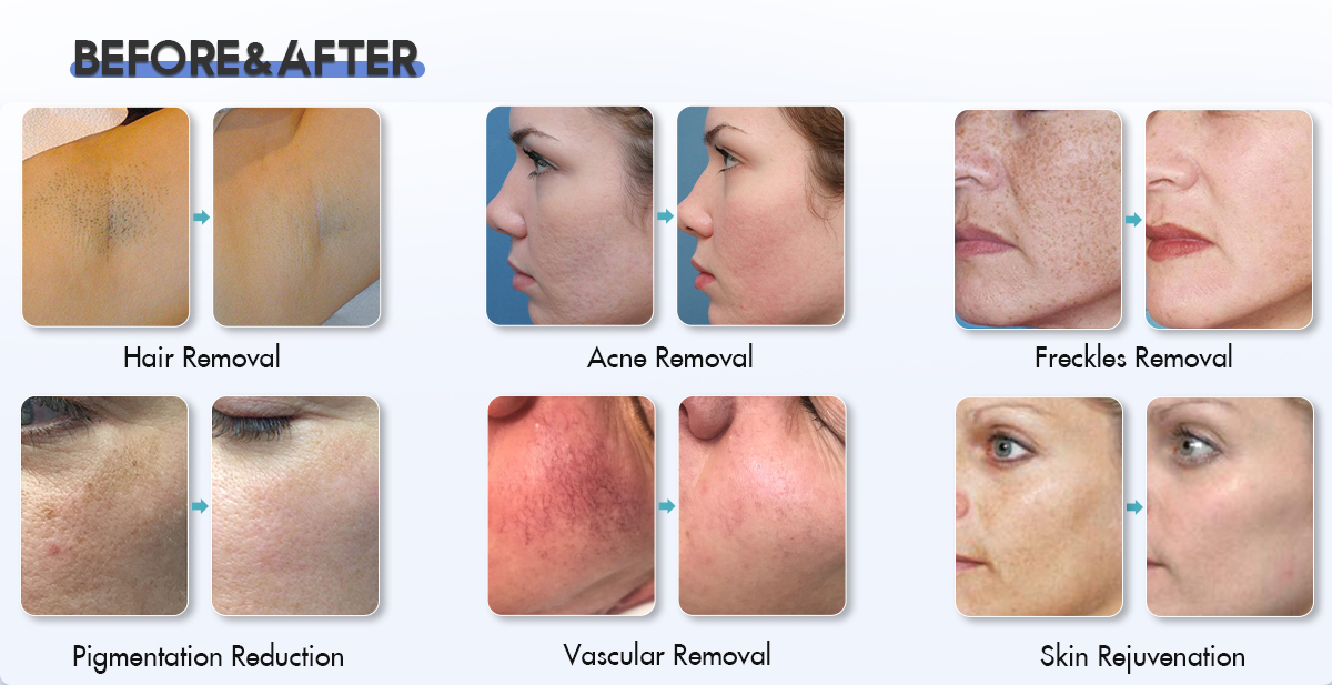 Opt_Shr_Ipl_Machine_For_Fast_Hair_Removal.jpg
