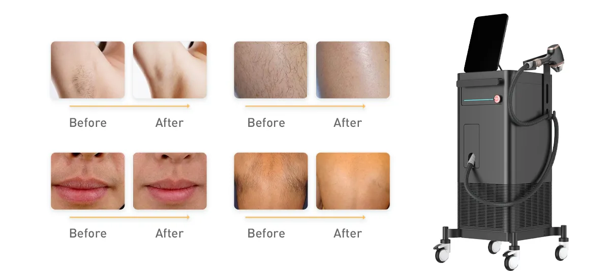 Comment choisir un fournisseur fiable de machine d'épilation au laser à diode